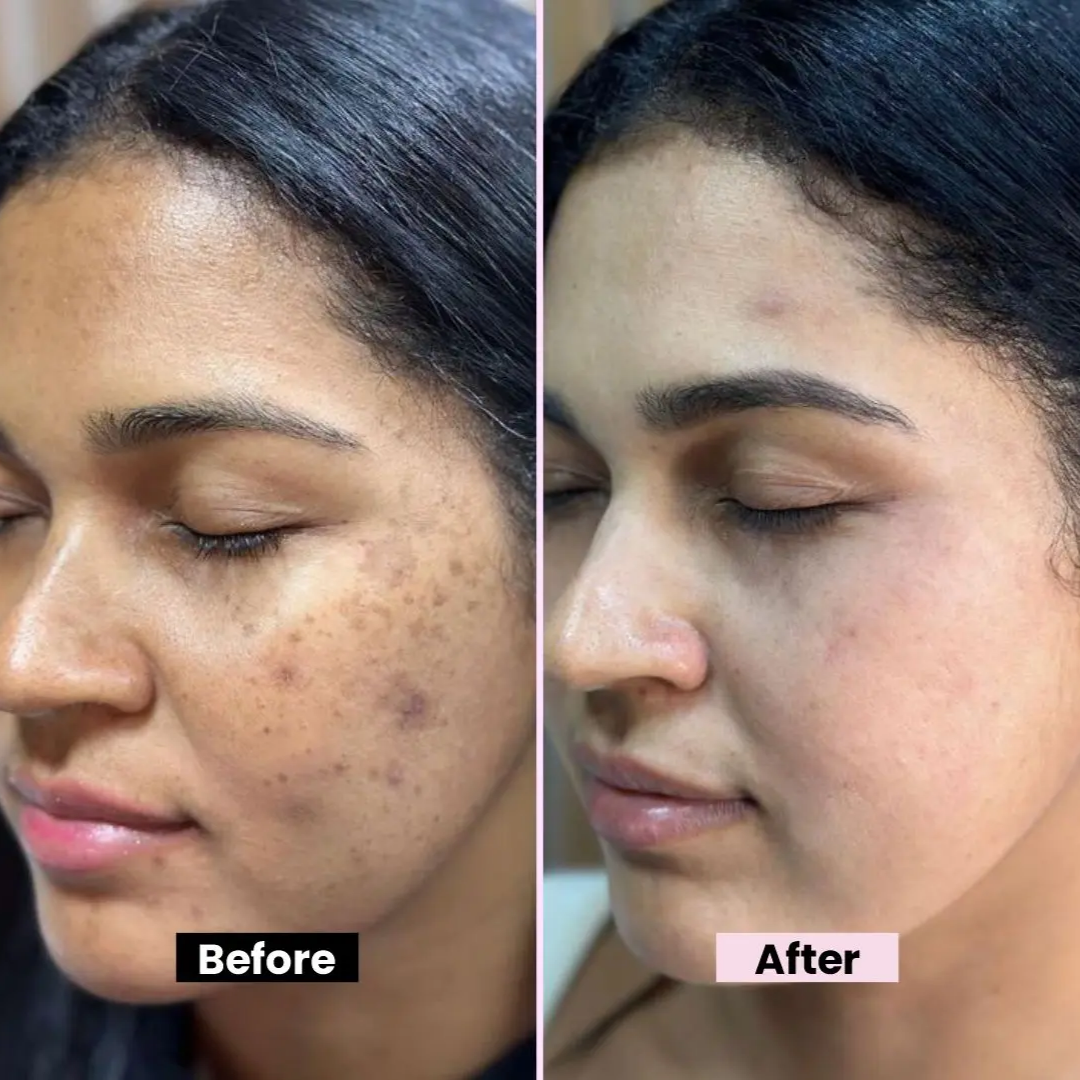 Chalonese Brightening Cream | (For both Men & Women)